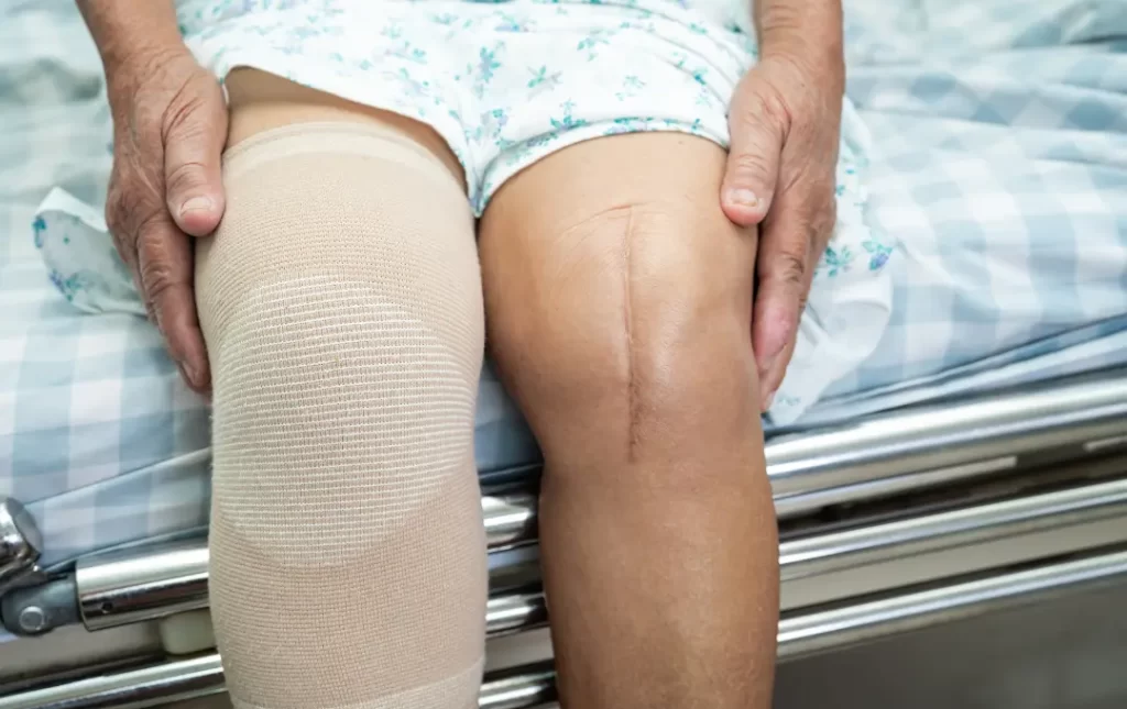 exactech recall revision surgery exactech knee replacement lawsuit knee replacement devices