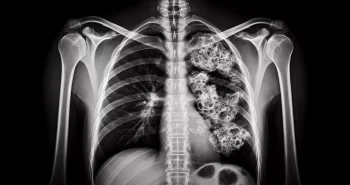 What a Mesothelioma X Ray Reveals and Why Early Detection Matters