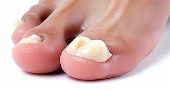 types of big toe implants