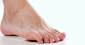 how long is recovery from big toe joint replacement