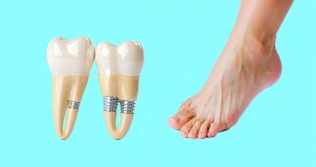 cartiva implant cost