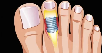 how long does cartiva implant last