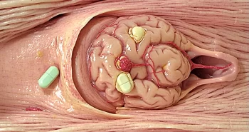 does depo provera cause brain tumors